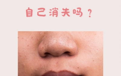 什么是黑頭？怎樣預(yù)防黑頭的形成？