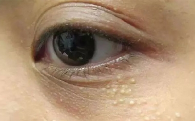 脂肪粒怎么樣才能去除？脂肪粒的去除方法！